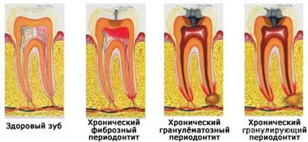 A periodontitis tünetei és kezelése