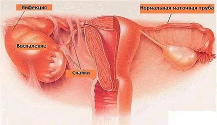 Piosalpinks tünetek, okok, dagnostika kezelés