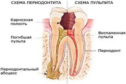 Simptomele parodontita si tratament