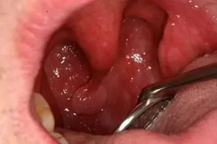 Защо е езика в гърлото увеличил, подути и възпалени, той се нарича