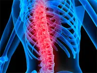Polysegmental osteochondrosis funkciók, tünetek és kezelés