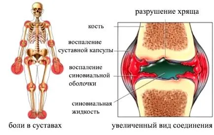 Arthritis на симптоми рамо ставни заболявания, методите за лечение