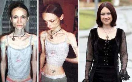 Lenyűgöző hasznosítás az emberek előtt és után anorexia umkra