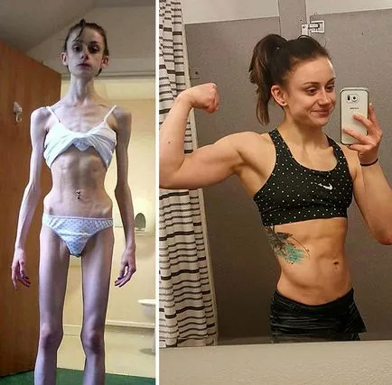 Зашеметяващи възстановяване на хора преди и след анорексия umkra