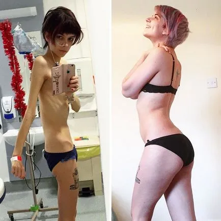 Зашеметяващи възстановяване на хора преди и след анорексия umkra