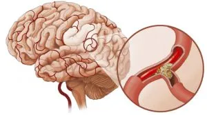 Cauze și simptome de vasospasm cerebral