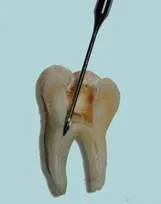 Jegyzőkönyv endodontikus kezelés