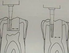 Jegyzőkönyv endodontikus kezelés