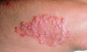 Psoriasis kezelése népi jogorvoslati otthon