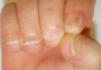 псориазис на ноктите