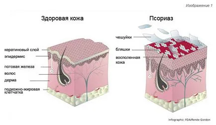 Псориазис лечение на народната медицина у нас