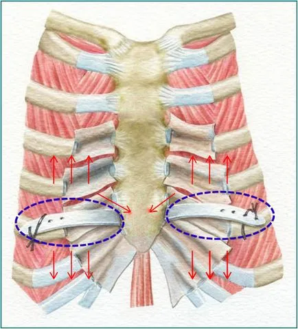 defect Rib-musculare - sindromul Polonia