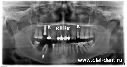 Komplex fogpótlás - integrált megközelítés „dial-dent”