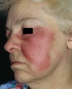 Rózsa - симптоми и лечение на инфекциозни заболявания на кожата