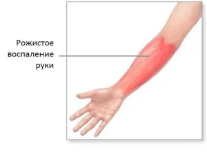 Rózsa - симптоми и лечение на инфекциозни заболявания на кожата