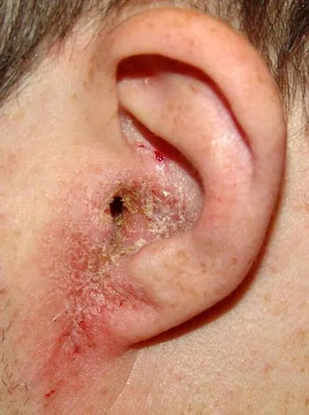 Себореен дерматит на лицето и скалпа причините и лечението на