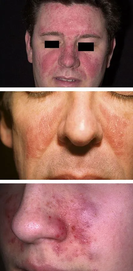 Себореен дерматит на лицето и скалпа причините и лечението на