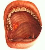 Сифилитична язви (венерически) в устата изглеждат като симптоми