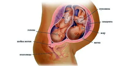 Разбъркване на близнаци по време на бременност основните признаци