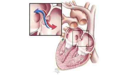 murmur cardiac la un copil cauze și diagnostic