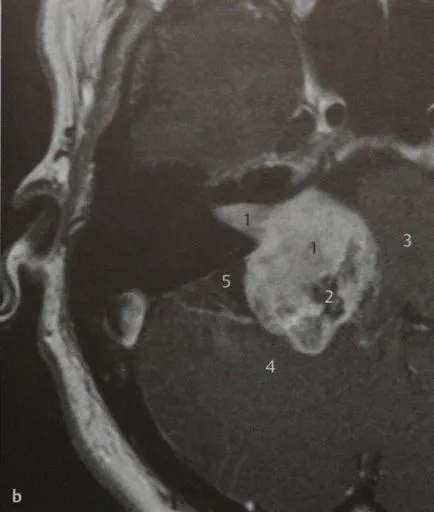 ъгъл шванома cerebellopontine