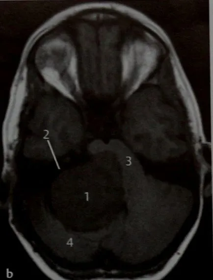 ъгъл шванома cerebellopontine