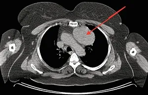 cancer la adulți simptome de glanda timus