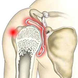 Симптоматика и лечение на артрит на раменната става