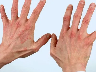 Обривът на ръцете, дланите, китките като червени точки, отколкото за лечение на обриви, каузи