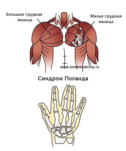 снимка синдром на Полша, причинява, лечение, наследственост синдром Полша, онлайн списание