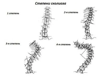 лечение на сколиозата, каузи