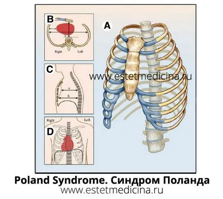 Lengyelország fotó szindróma okozza, a kezelés, az öröklődés Lengyelország szindróma, egy online folyóirat