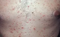 psoriasis progresszív lépést és a helyhez kötött