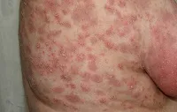 psoriasis progresszív lépést és a helyhez kötött