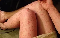 psoriasis progresszív lépést és a helyhez kötött