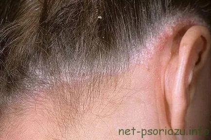 Lépés psoriasis, a tünetek és patológia kezelésére