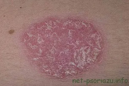 Lépés psoriasis, a tünetek és patológia kezelésére