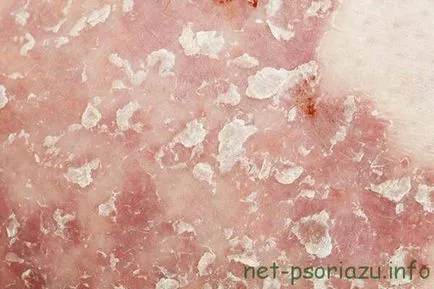 Lépés psoriasis, a tünetek és patológia kezelésére