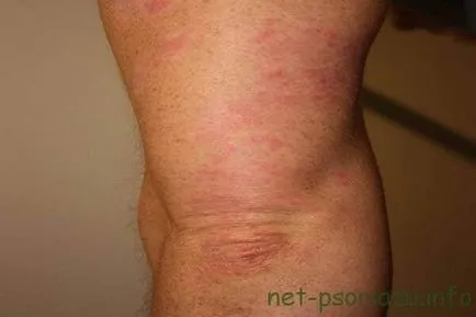 Lépés psoriasis, a tünetek és patológia kezelésére