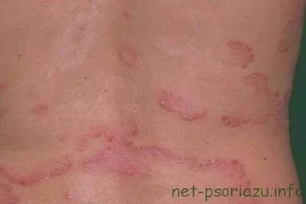 Lépés psoriasis, a tünetek és patológia kezelésére