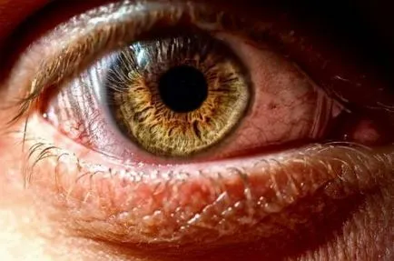 Uscăciunea ochilor (xeroftalmie) - Cauzele și tratamentul sindromului de ochi uscat