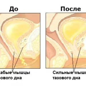 Упражнения с простатит за Kegel