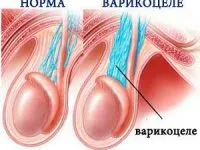 Varicocele és a prosztatagyulladás krónikus betegségek kezelésére a hím és a kockázat a meddőség