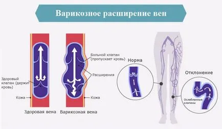 Varicele în picioare provoacă vene varicoase