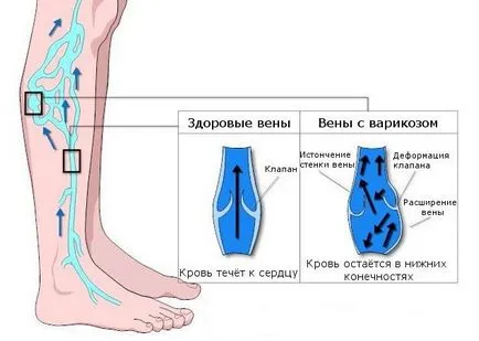 Varicele în picioare provoacă vene varicoase