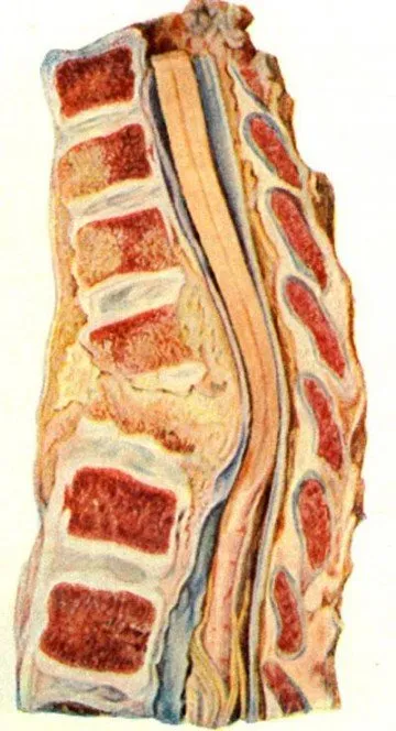 spondilita tuberculoasă