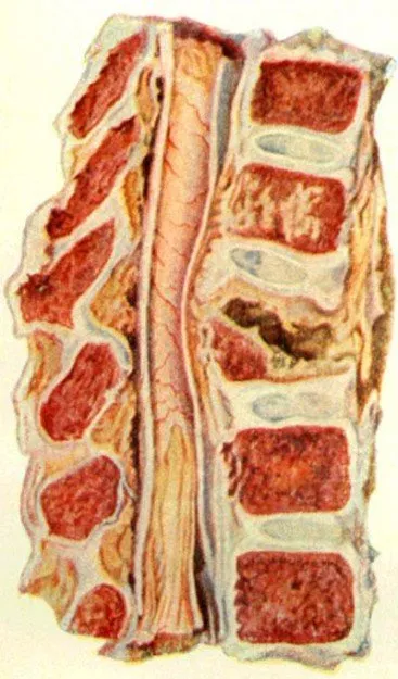 spondilita tuberculoasă