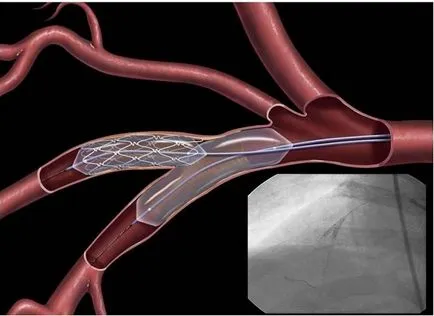 Stentarea arterei iliace femurale în centru cu Kapranova