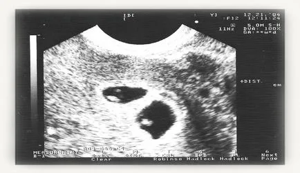 Вероятността за раждане на близнаци какво и как да се увеличи