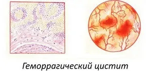 Simptomele cistitei virale si tratament